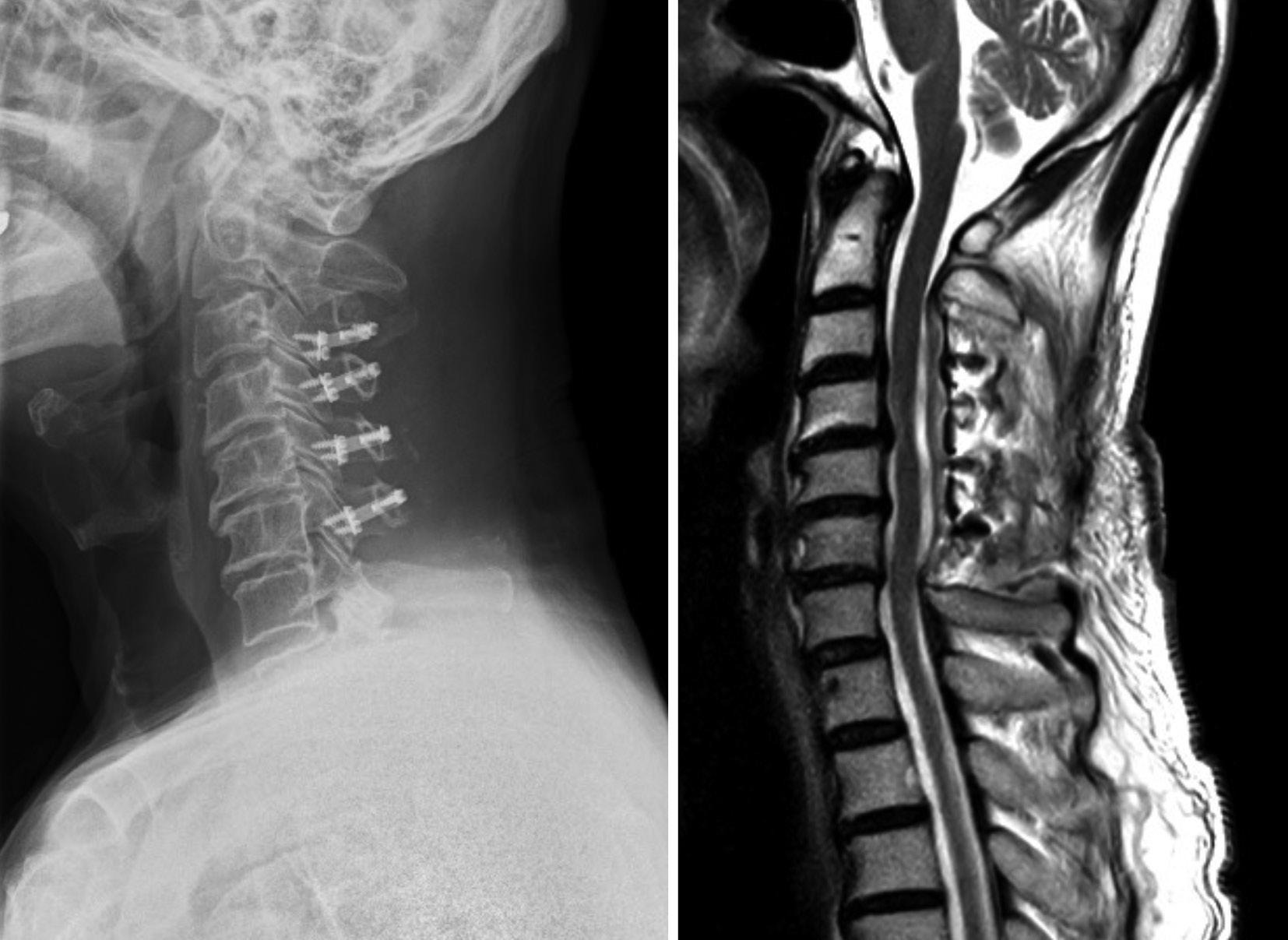 術後X線とMRI